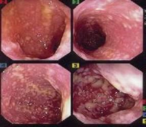 Fulminant Colitis Fulminant colitis (severe sudden inflammation of the colon), is frequently associated with very