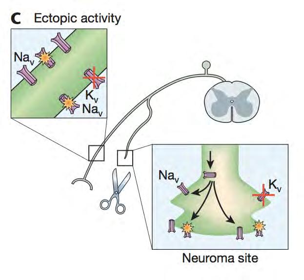 Neuroma Ectopic Activity Injury leads to: Mechanical sensitivity Focal demyelination of A- fibers at site of injury Ectopic activity Proliferation of Nav 1.7 and 1.