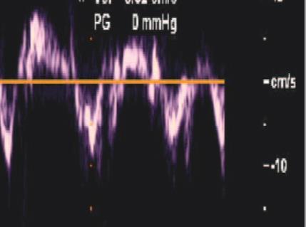 75 year old woman with HFPEF 2018 MFMER 3712003-39 VBaseline Primary CP Secondary CP Primary CP