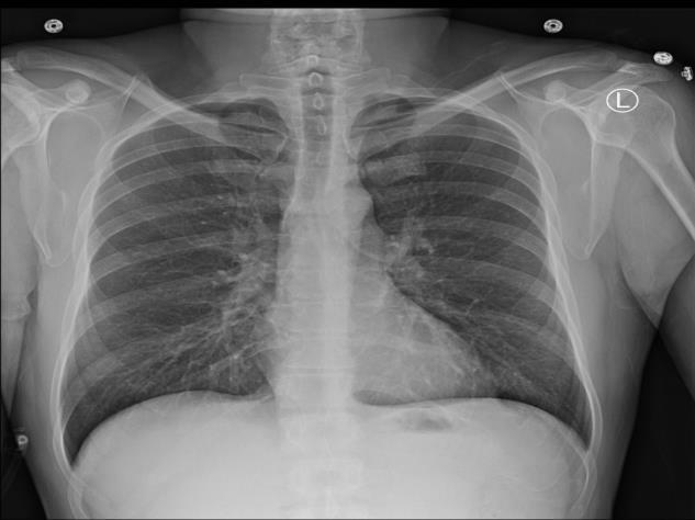 What is the most common cause of HF seen in this 42 year old man? SV= (2.3) 2 x 0.