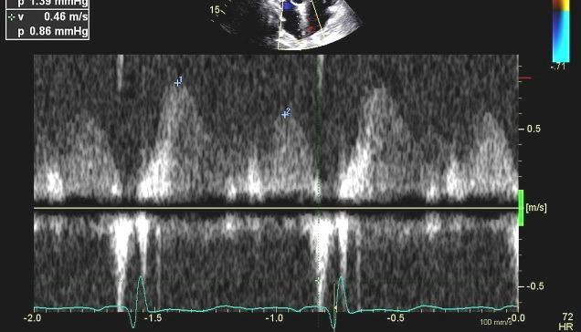 80 YO man with dyspnea Septal e is reduced due to PHT 1. e is reduced 2.