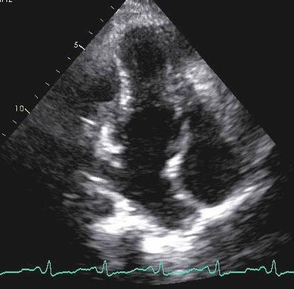 month after acute pericarditis and pericardial