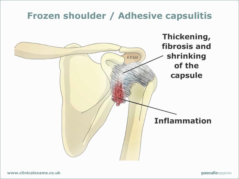 Review of Adhesive Capsulitis Painful and restricted active and passive ROM in both