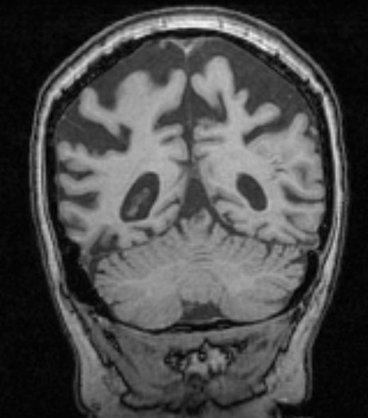 Posterior Cortical