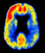 Amyloid imaging with