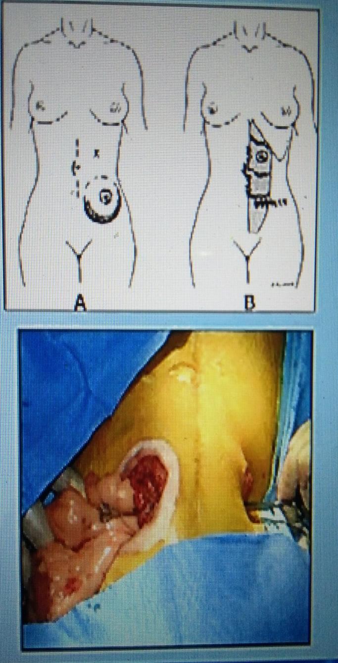 B- Stoma Relocation: - Relocation to the other side of abdominal wall is associated with lower recurrence rates (57 vs.