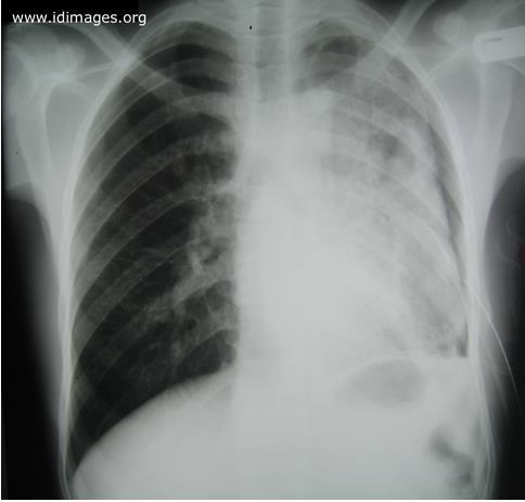 Case 1 With lung re-expansion, a parenchymal cavity was evident The patient was referred for