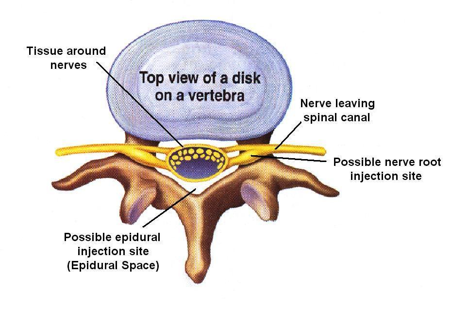 Selective Nerve Root Block What is a selective nerve root block? Selective nerve root blocks is similar to epidural injections, as the preparation and approach is identical.