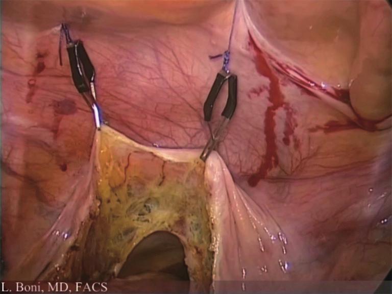 narrow pelvis, the anterior peritoneal reflection can be lifted up with stitches or dedicated intra-abdominal retractor and suspension systems (VersaLifter, Surgical Perspectives, Strasbourg, France)