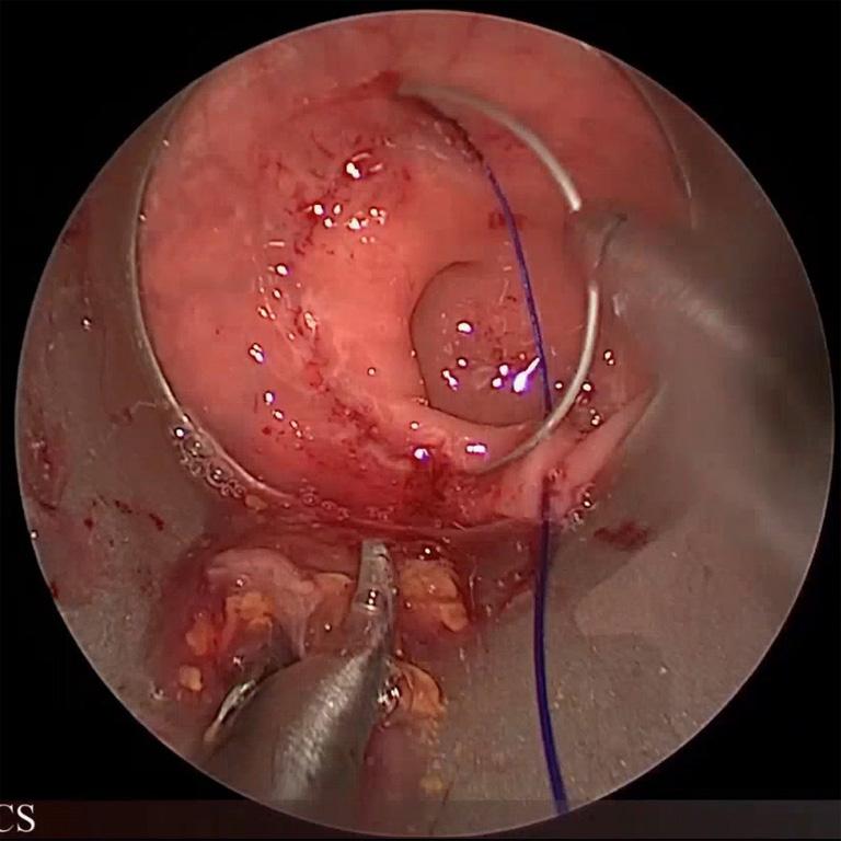 Once ligature of the inferior mesenteric vessels is performed and the descending colon mobilized, we recommend to close temporarily sigmoid colon by means of a long forceps, in order to avoid