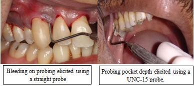 Microbial sampling and isolation of Porphyromonas gingivalis by culture Microbial sampling on periodontitis patients was performed on pockets 4 mm.