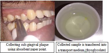 After removing supragingival plaque with curettes and isolating the area with cotton pellets, the absorbent paper points were inserted into each