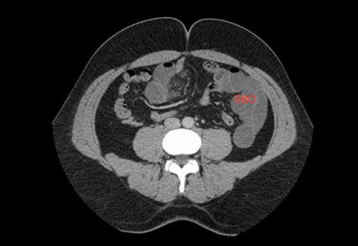 Han et al. 304 CASE REPORT A 32-year-old male was presented to Dubbo base hospital with sudden onset abdominal pain, abdominal distension, vomiting and absolute constipation for one day.
