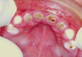 child s teeth as chipping or melting away.