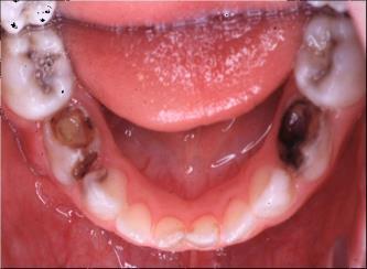 Abscess of Mandibular First Molar Can Be Anesthetized Abscess of Maxillary First Molar That Is Difficult to Anesthetize Abscesses Associated with Dental Caries Immediate treatment dependent on