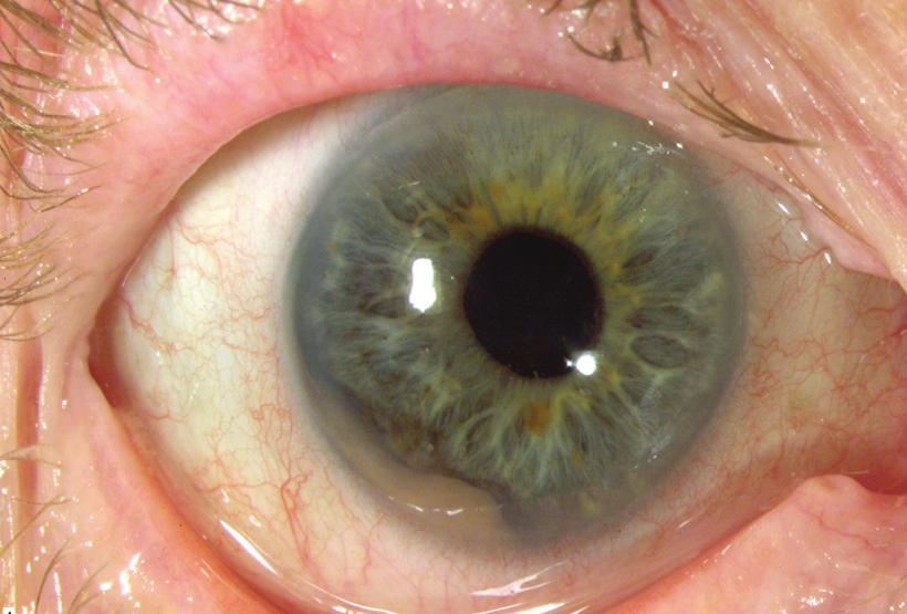 extrascleral extension.