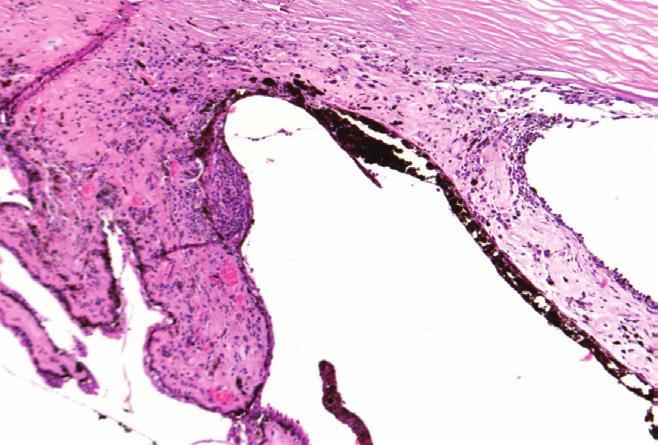 (original magnification: x10) E: Histology showing melanoma