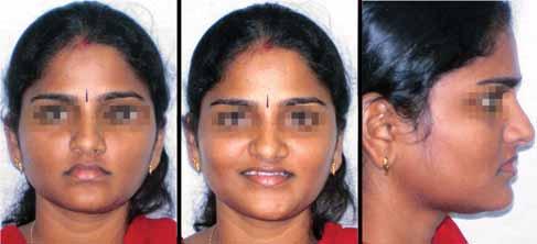 Nidhi Kedia, Ashima Valiathan CASE REPORT The patient was a 23-year-old girl. Her chief complaint was spacing in upper teeth.