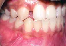 She had an Angle s Class I molar relationship with missing right lateral incisor, with an edge to edge bite. There was 1.