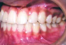 After desired amount of space was opened and uprighting of teeth took place with midlines being coincident with facial midline, settling