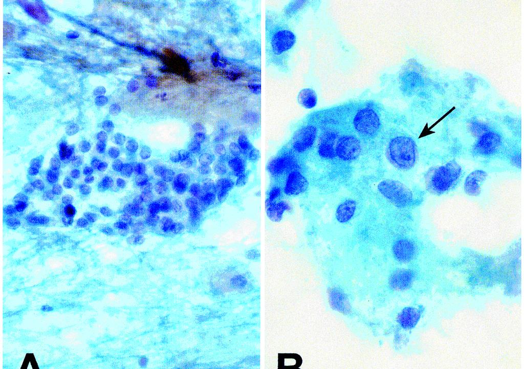 FIG. 3. Nuclear grooves, a rare feature of the follicular variant of papillary thyroid carcinoma, as a cause of a false negative finding.