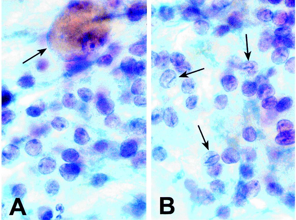 B: Rare cells show distinct nuclear grooves (arrow) but without intranuclear inclusions (10003, Papanicolaou stain). FIG. 4.