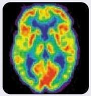 Brain Changes in Dementia 4 PET and Aging: PET Scan of 20-Year-Old Brain PET Scan of 80-Year-Old Brain