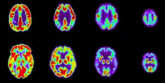 year 17 Positron Emission Tomography (PET) Alzheimers Disease Progression vs.