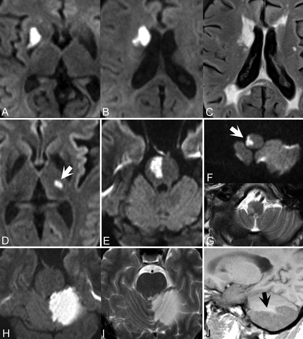 Fig. 14.1 substantia nigra and cerebral peduncle. Unlike lacunar infarcts, they are isointense to CSF on FLAIR and do not demonstrate restricted diffusion.