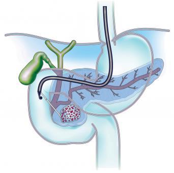 Pancreatic Cyst