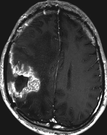 Background ü Glioblastoma has an unfavorable prognosis mainly due to its high propensity for tumor recurrence.