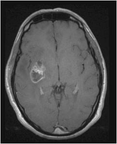 Brain MRI (T1-weighted with gadolinum) showing recurrence was co-registrated with original CT scan of RT planning: RT was delivered with 3D-CRT technique or