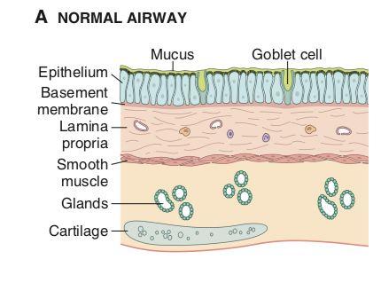 Bronchial Asthma Definition: a chronic inflammatory disorder of the airways that causes recurrent episodes of wheezing1, breathlessness, chest tightness and cough.
