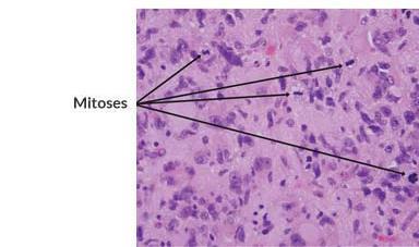 Features of anaplasia: increased mitosis this pic shows