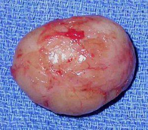 Lack of invasion in benign tumour This pic shows a benign encapsulated tumour.