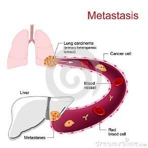 4. Metastasis (mets) Metastais= secondary implants of the tumor which are discontinuous with the