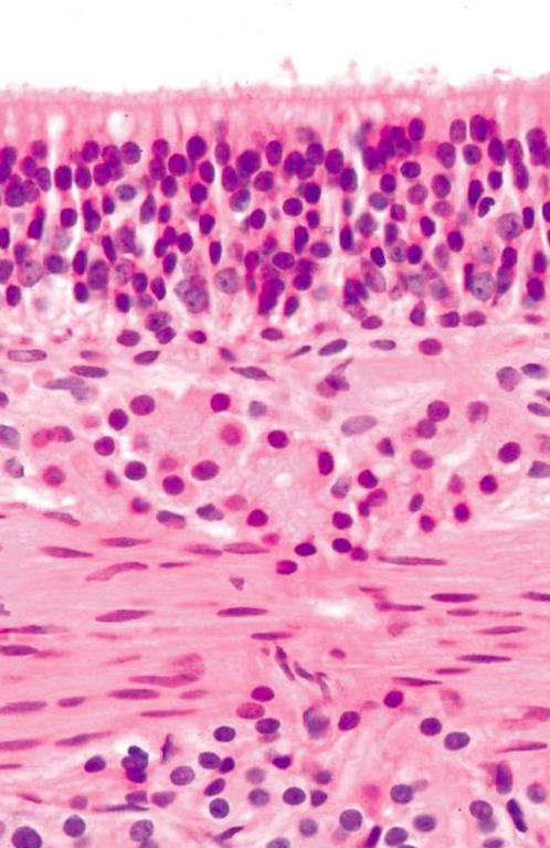 Normal Respiratory epithelium This is another example of normal epithelium Note that we can draw a line at the base.
