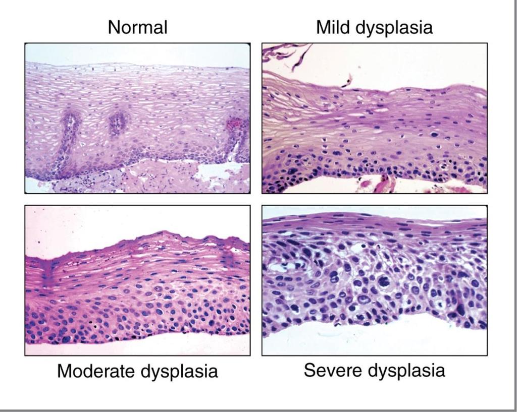 This pic compares normal to dysplasia of several grades.
