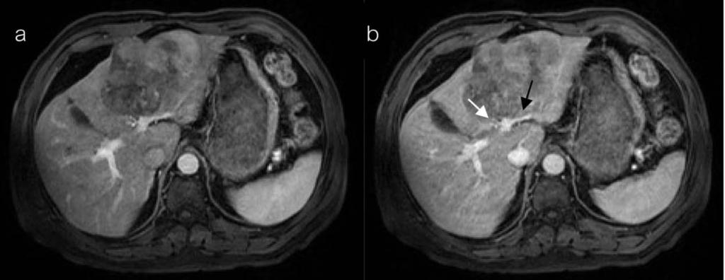 122 L. Vajragupta, et al. Fig. 10 A 70-year-old man had large poorly differentiated HCC in the left hepatic lobe with portal venous invasion.