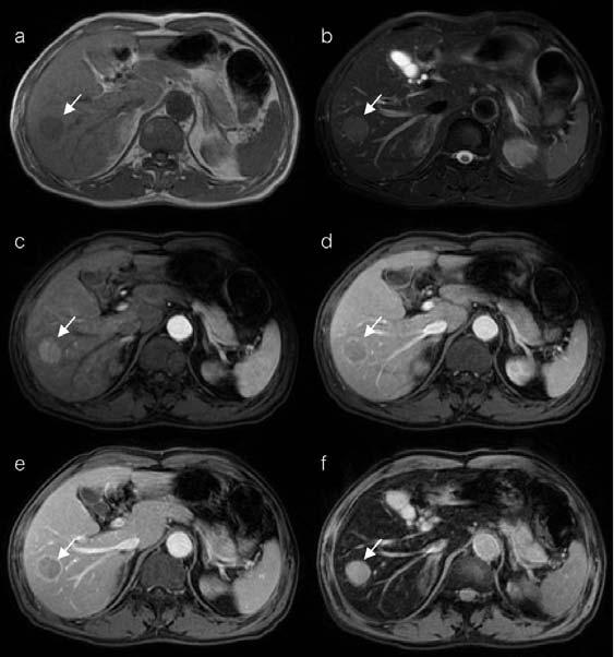 116 L. Vajragupta, et al. Fig. 1 A 69-year-old man had a 2.7 cm moderately differentiated HCC in the right hepatic lobe (indicated by arrows).