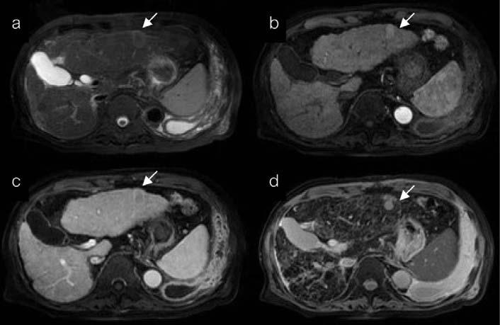 Vol. 4 No. 1 February 2010 MR imaging findings of hepatocellular carcinoma 117 Among 44 HCC that were smaller than or equal to 2 cm, 29 lesions were hypointense (65.9%), seven were isointense (15.