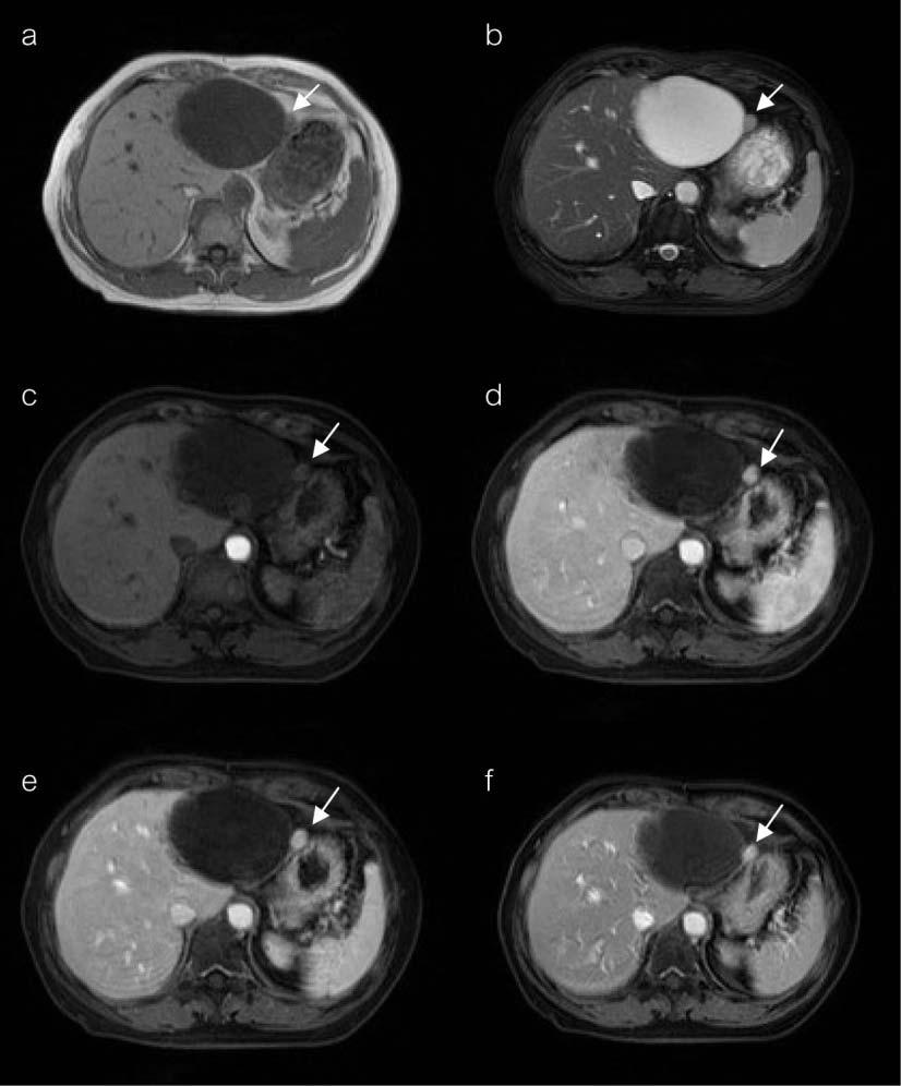 118 L. Vajragupta, et al. Fig. 4 A 73-year-old woman had a 1.1 cm HCC in the left hepatic lobe (indicated by arrows) adjacent to the large hepatic cyst.
