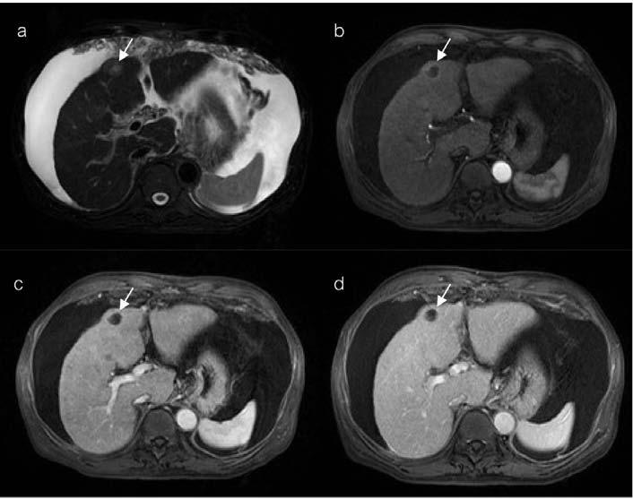 Vol. 4 No. 1 February 2010 MR imaging findings of hepatocellular carcinoma 119 five lesions (5%) (Fig. 9), all of them are more than 2 cm in size. Capsules were identified in 62 lesions (62%) (Fig.
