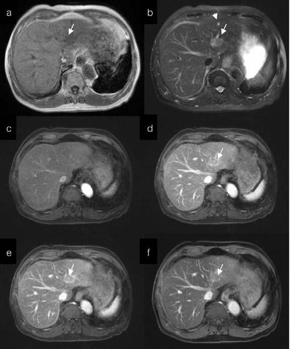 120 L. Vajragupta, et al. Fig. 6 A 78-year-old man had a 2.3 cm HCC in the left hepatic lobe (indicated by arrows).