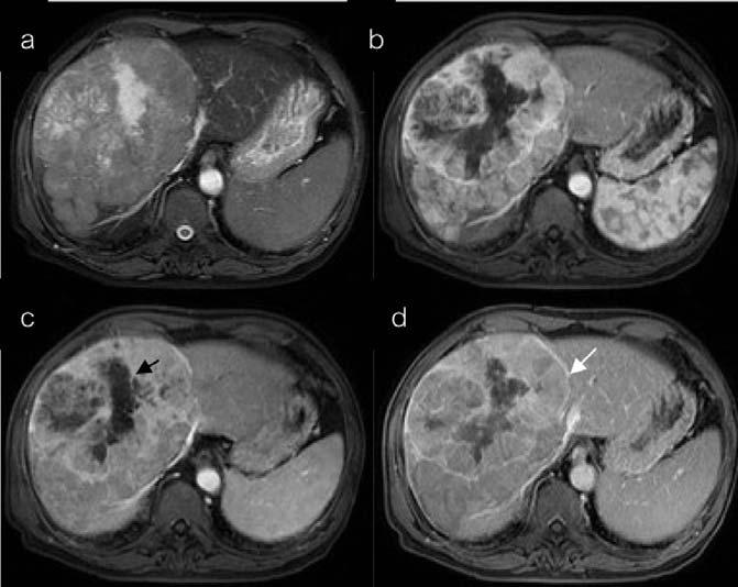 Dynamic contrast-enhanced study of this patient was shown in Fig. 5. Fig. 9 A 73-year-old man had huge HCC with central necrosis in the right hepatic lobe.