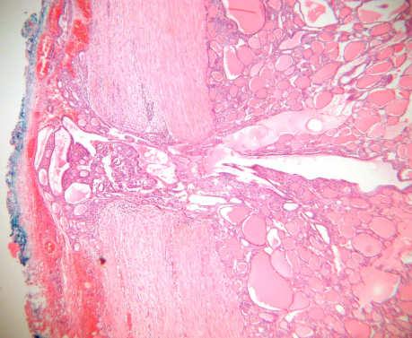 Follicular Carcinoma solitary encapsulated invades veins bone and lungs when metastasizes neck nodes
