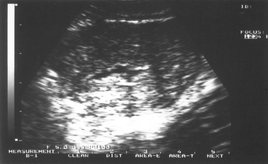 FIGURE 2 Transverse section of the uterus at the end of the procedure. The uterine cavity appears as an anechoic area with regular contours.