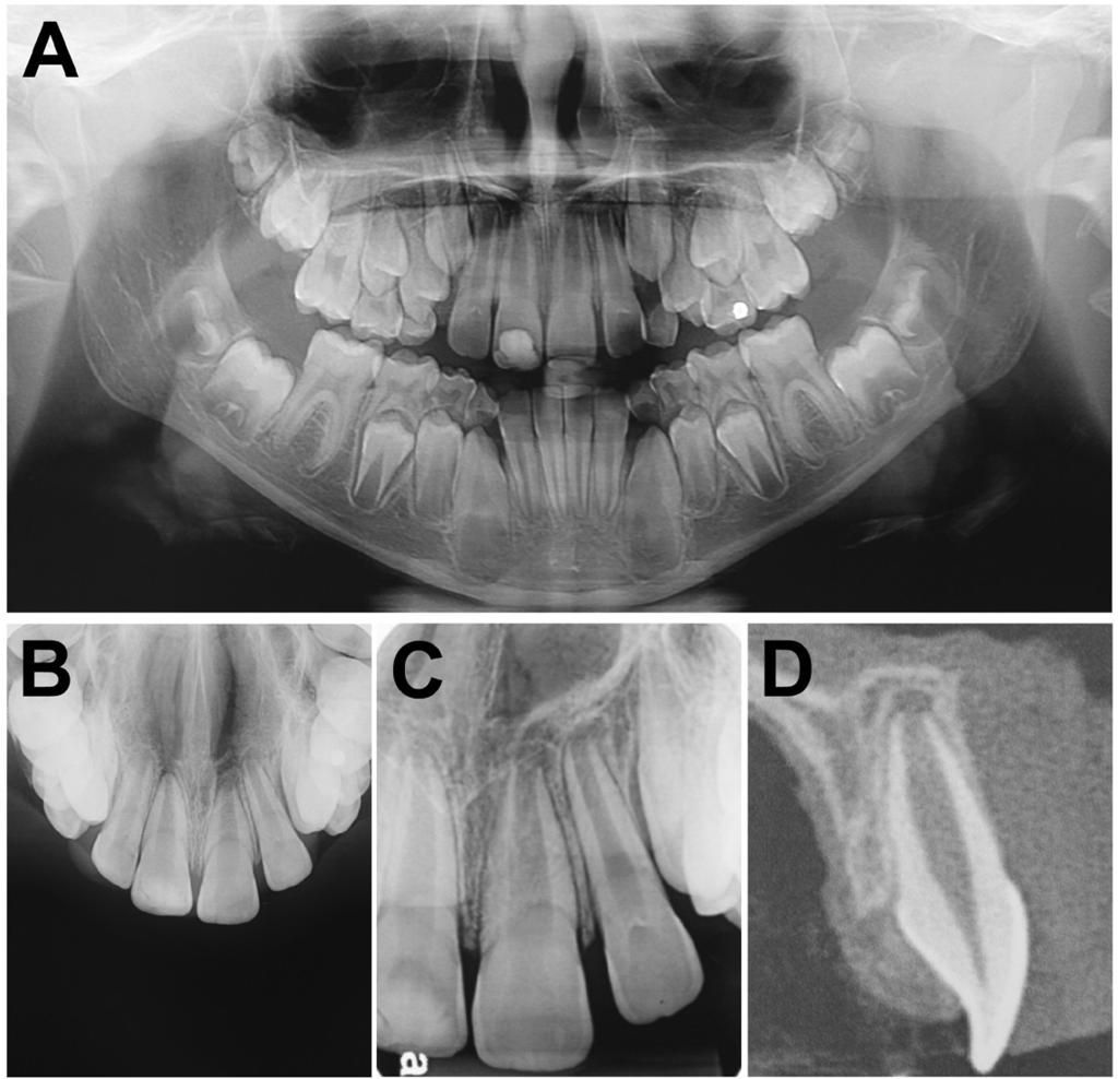 Fig. 2: A: Panoramic radiography with no related bone alterations; B: Occlusal radiography with no related bone alterations; C: Periapical radiography with no related bone alterations; D: Cone beam