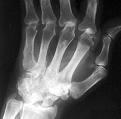 Radiographic progression of damage in rheumatoid arthritis
