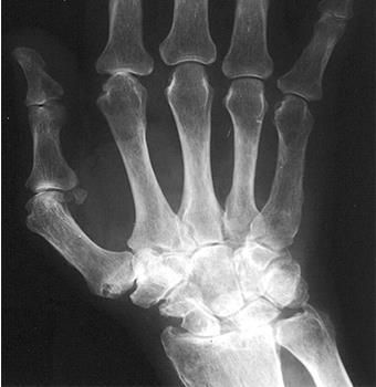 Erosions (arrow) bone defects next to the involved joints